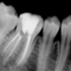Root Canal Treatment